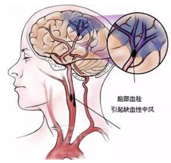 臻多美:最容易堵塞的血管是?